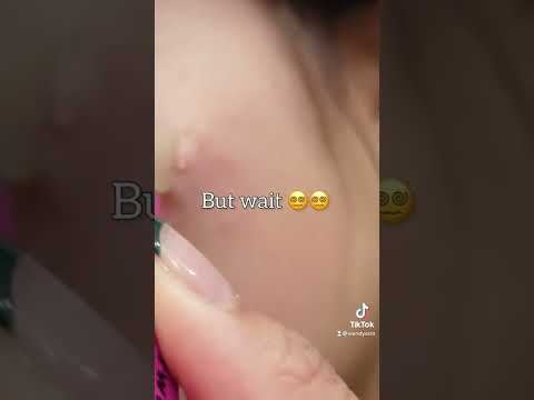 testing out my ✨PIMPLE PATCH✨ (disappointed)